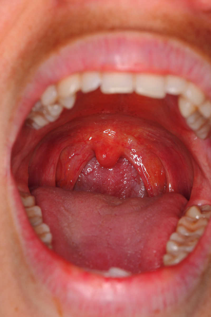 腭舌弓长疙瘩图片图片