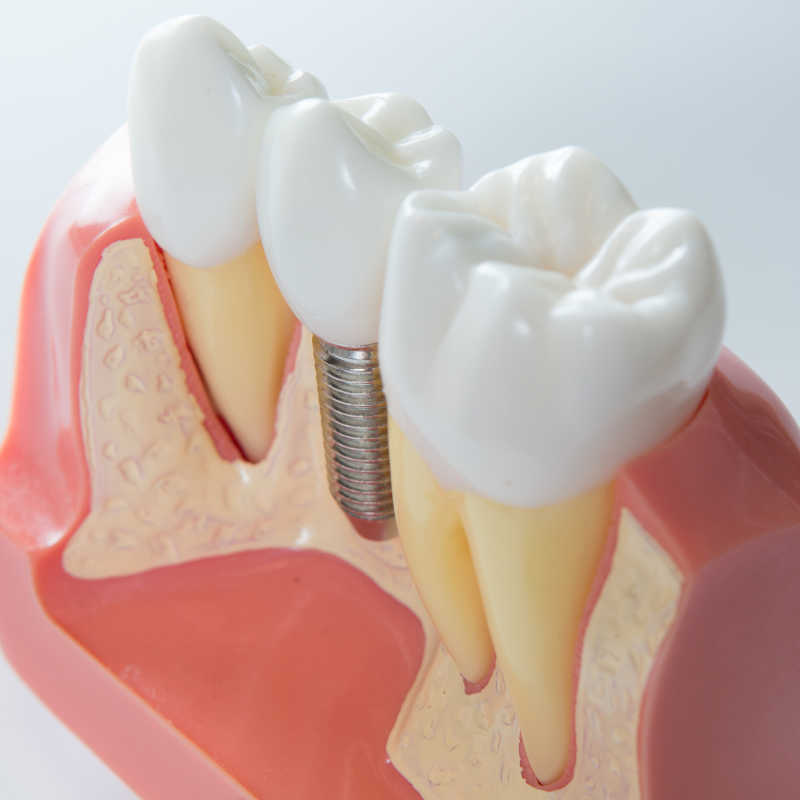 白色背景下牙科模型展示的种植牙