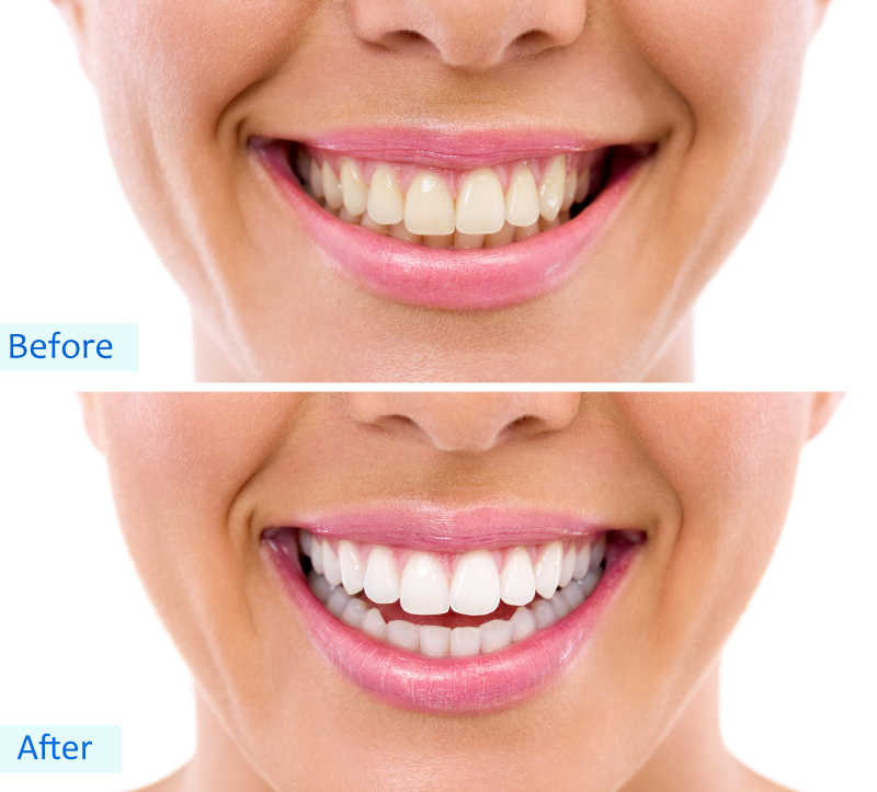 女人漂白后的牙齿对比