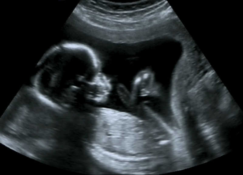 四个月胎儿的产科超声检查
