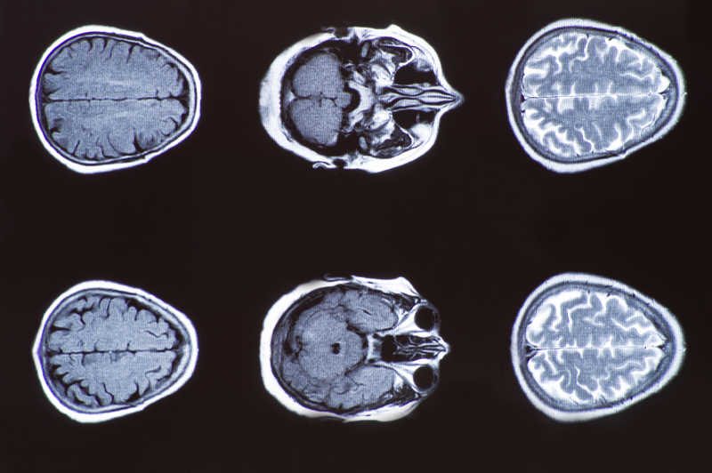脑ct的X射线图像