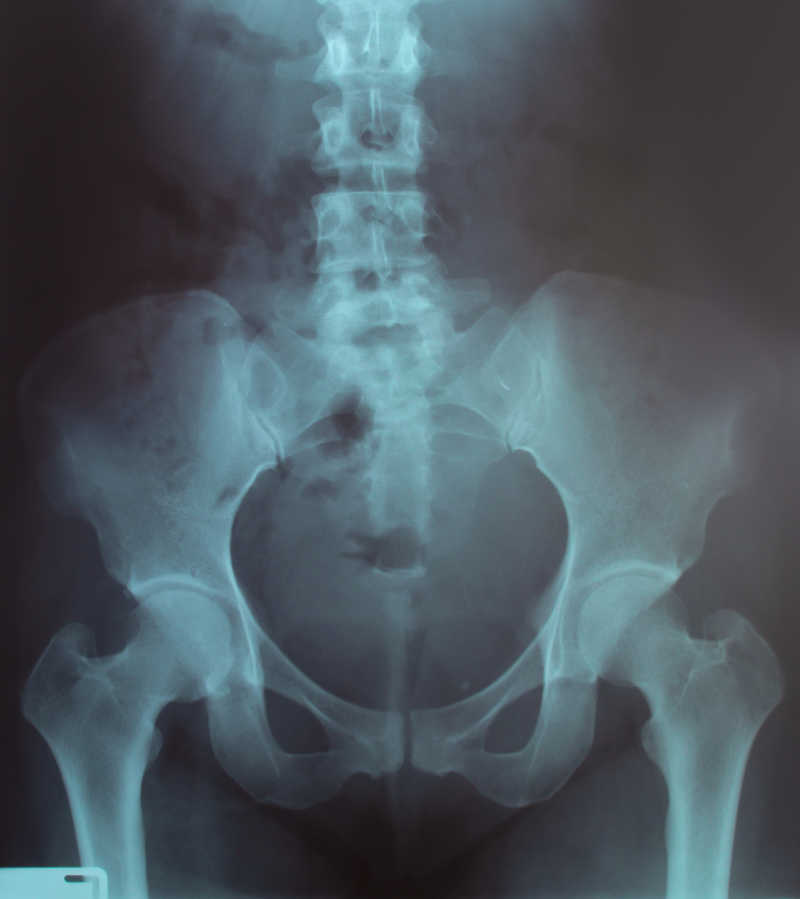 X射线股骨颈骨折