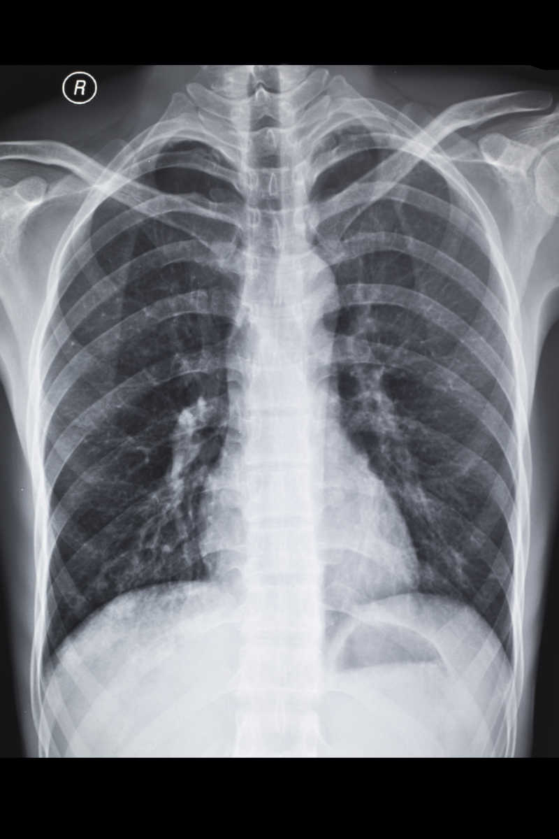肺部X射线图像