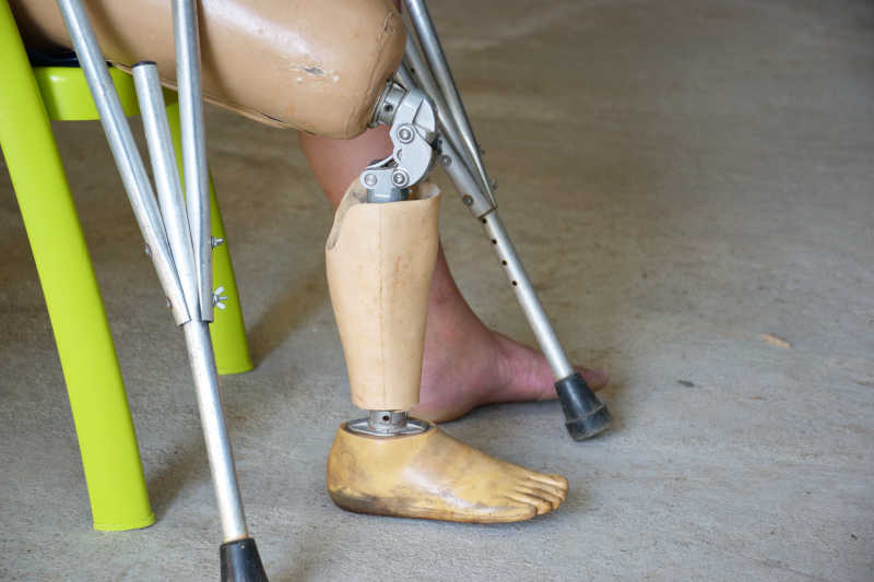 右腿和拐杖假肢的闭合膝关节
