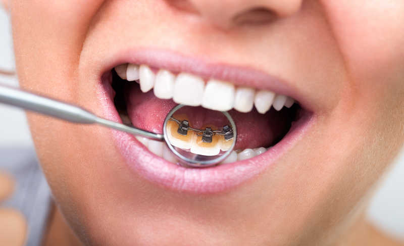 在隐形镜上展示隐形舌撑牙套的女人
