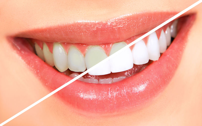 年轻女人牙齿的两种状态对比