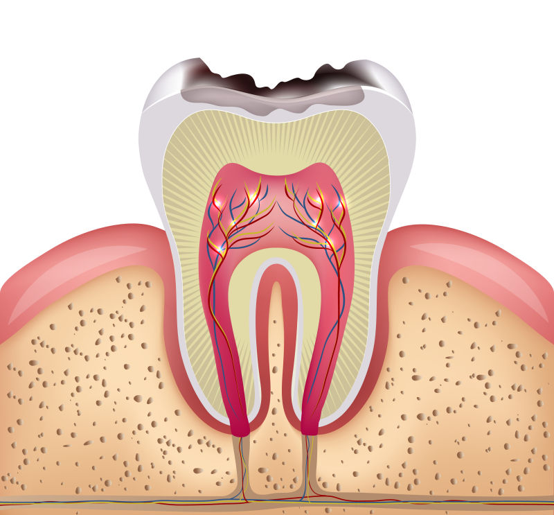 矢量蛀齿牙的横断面