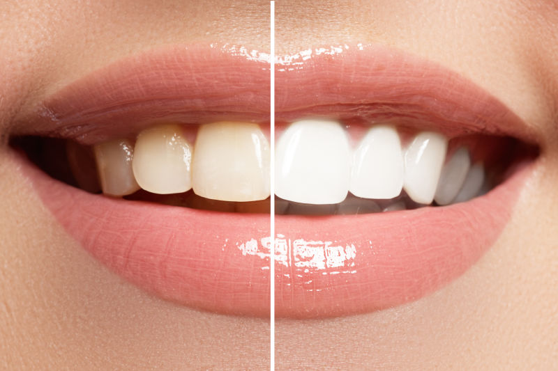 牙齿的洁白度对比