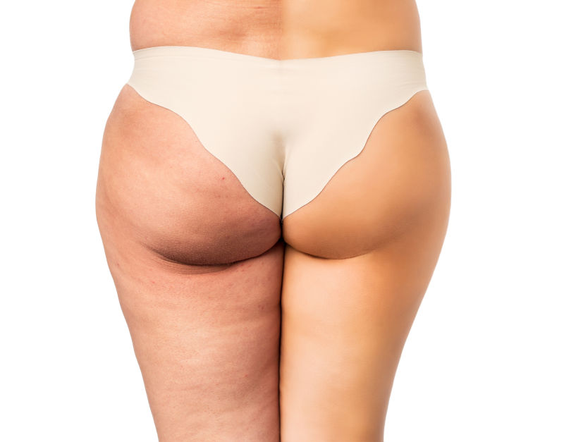 白色背景上臀部前后脂肪组织的对比