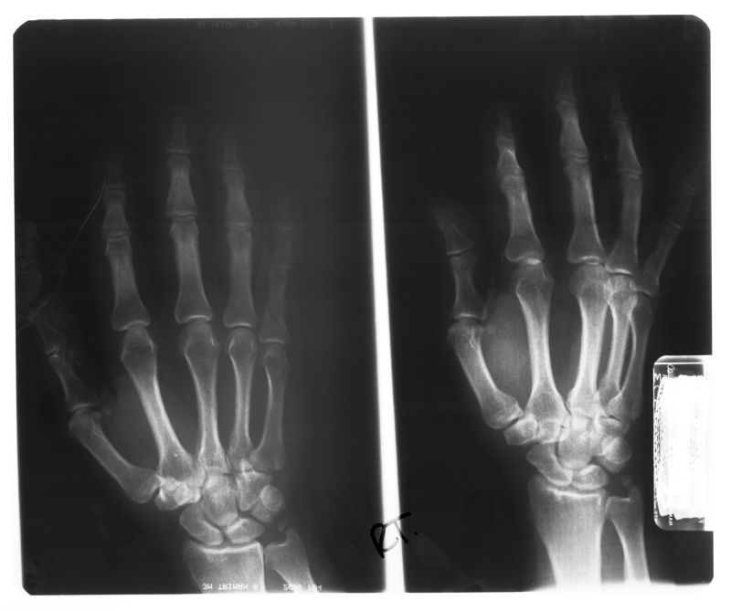 抽象骨骼手掌x射线片子