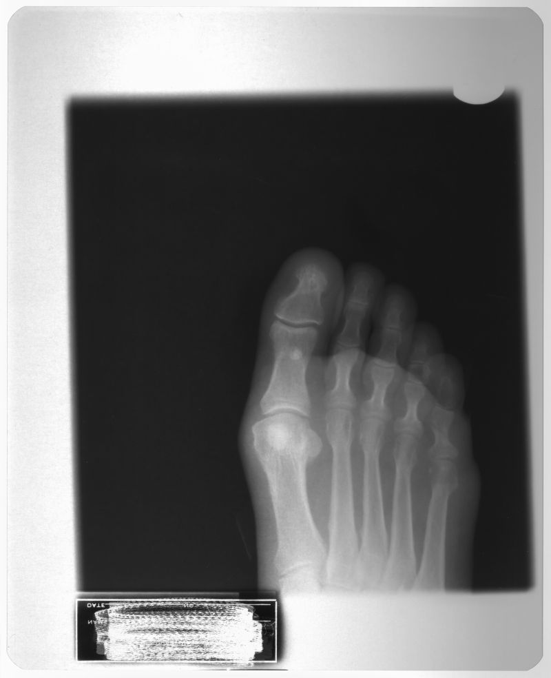 前脚掌骨骼x射线片子