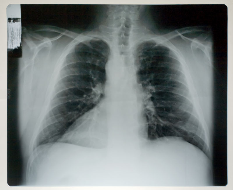 人体的肺部x射线片子