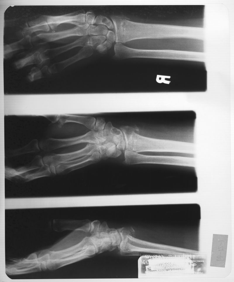 三张手腕骨骼x射线片子