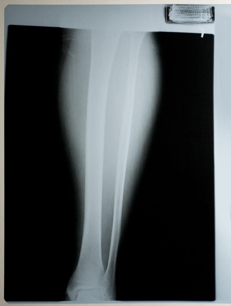 人体腿部骨骼x射线片子