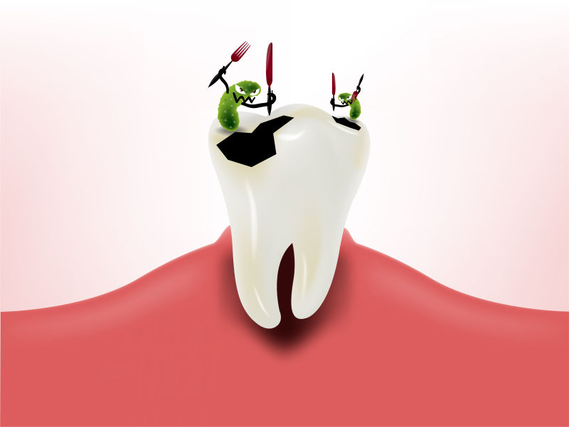 矢量破坏牙齿的细菌