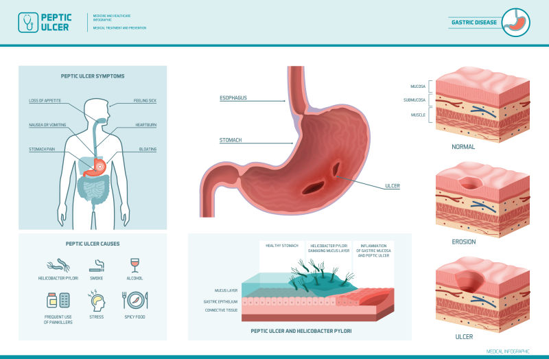 抽象矢量现代胃部溃疡主题的医疗信息插图设计