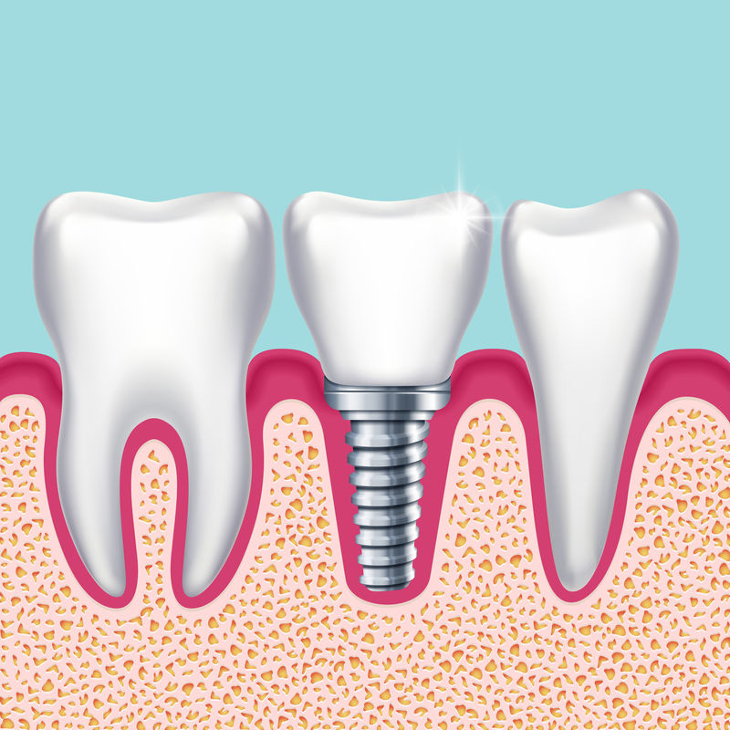 人牙与牙种植体在口腔正畸医学载体中的应用